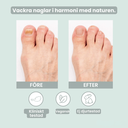 NagelRen - Din lösning mot nagelsvamp